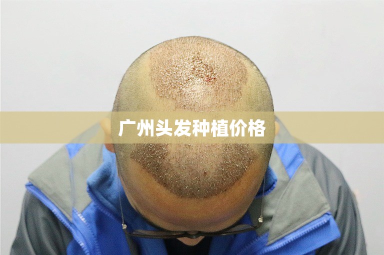 广州头发种植价格