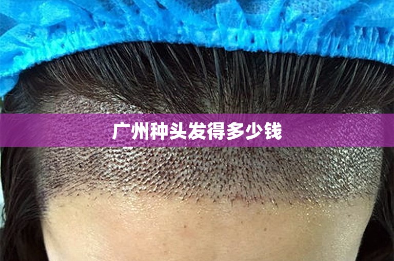 广州种头发得多少钱