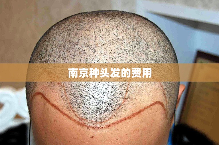 南京种头发的费用