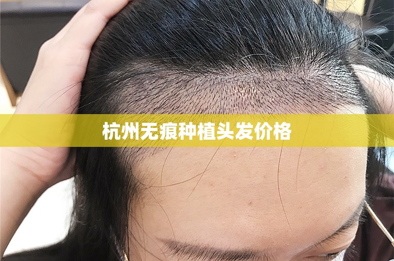 杭州无痕种植头发价格
