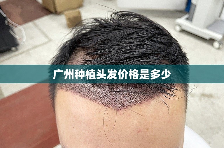 广州种植头发价格是多少