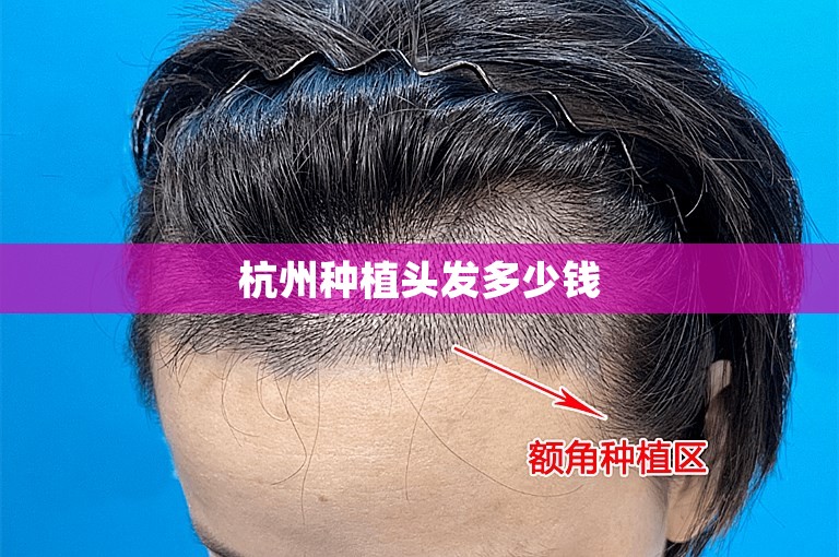 杭州种植头发多少钱