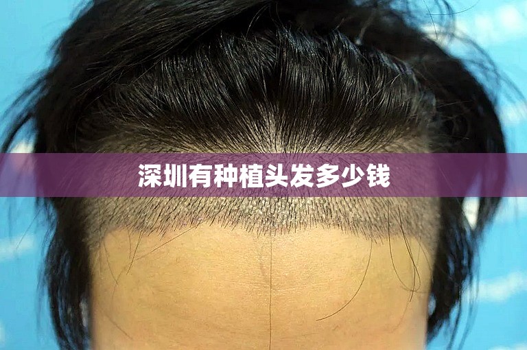 深圳有种植头发多少钱