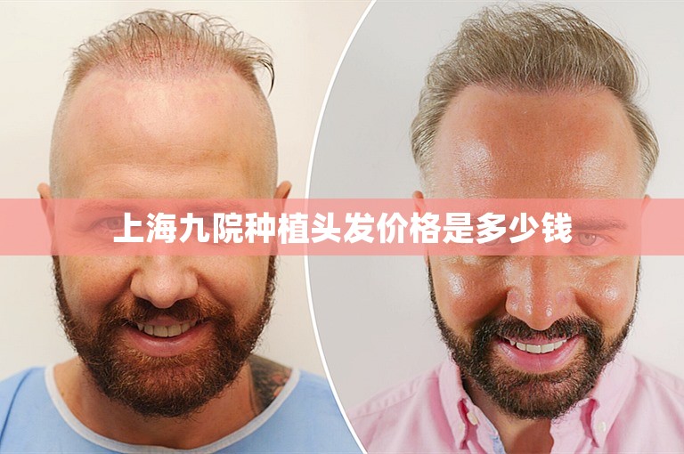 上海九院种植头发价格是多少钱
