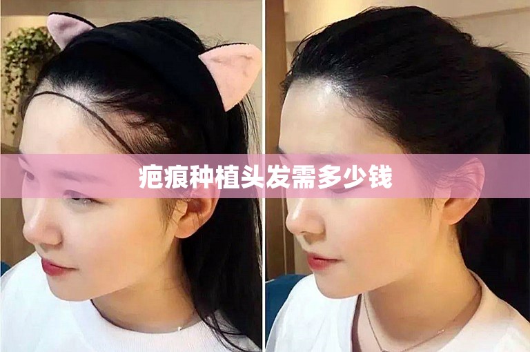 疤痕种植头发需多少钱 疤痕种植头发需多少钱