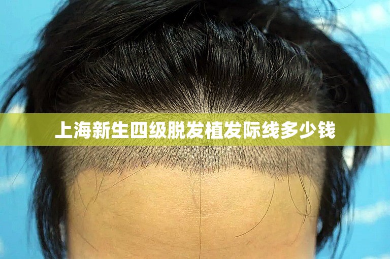 上海新生四级脱发植发际线多少钱