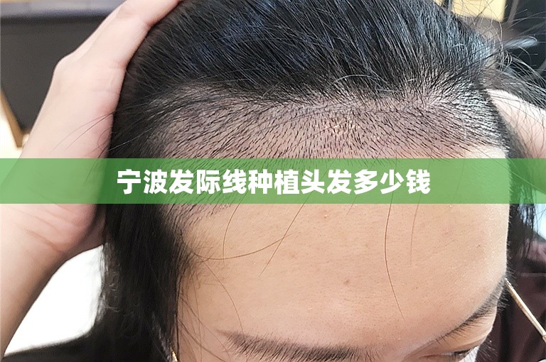 宁波发际线种植头发多少钱