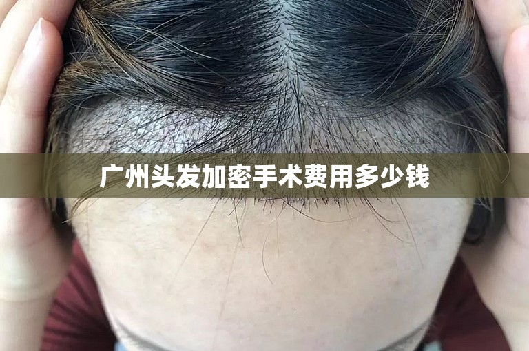 广州头发加密手术费用多少钱