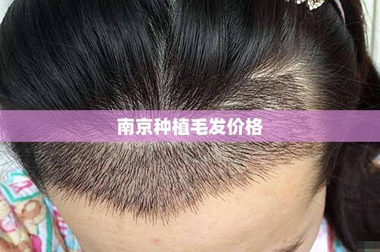 南京种植毛发价格