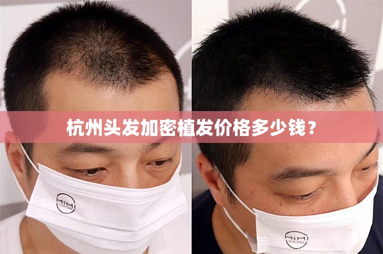 杭州头发加密植发价格多少钱？