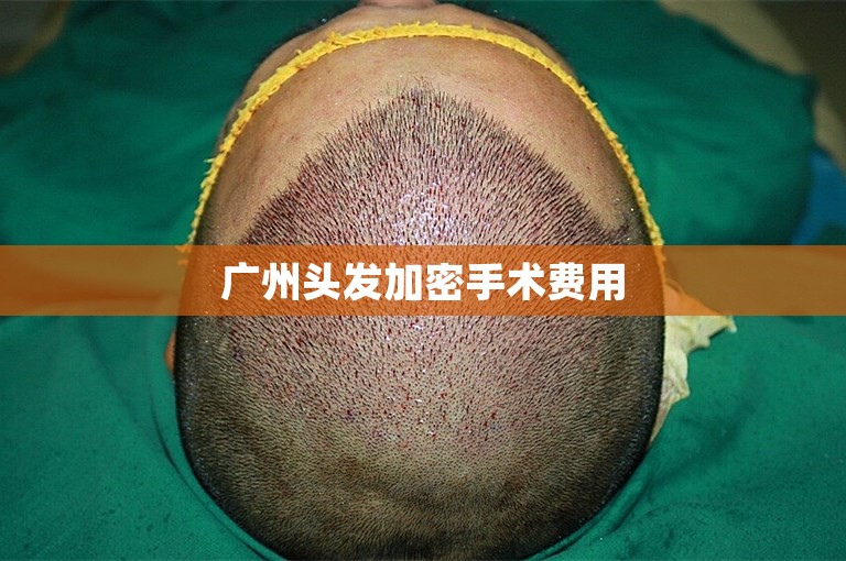 广州头发加密手术费用