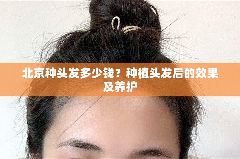 北京种头发多少钱？种植头发后的效果及养护
