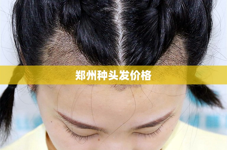 郑州种头发价格