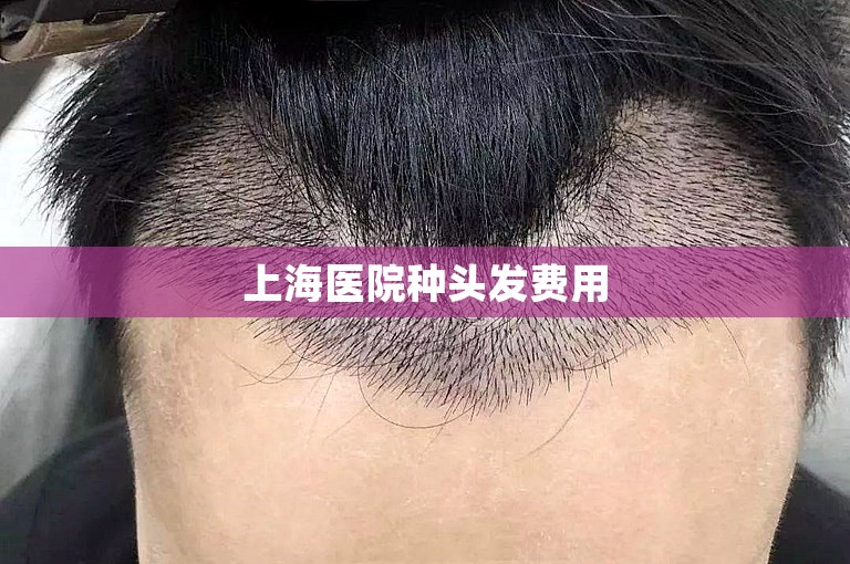 上海医院种头发费用
