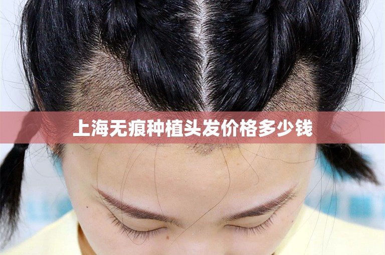 上海无痕种植头发价格多少钱