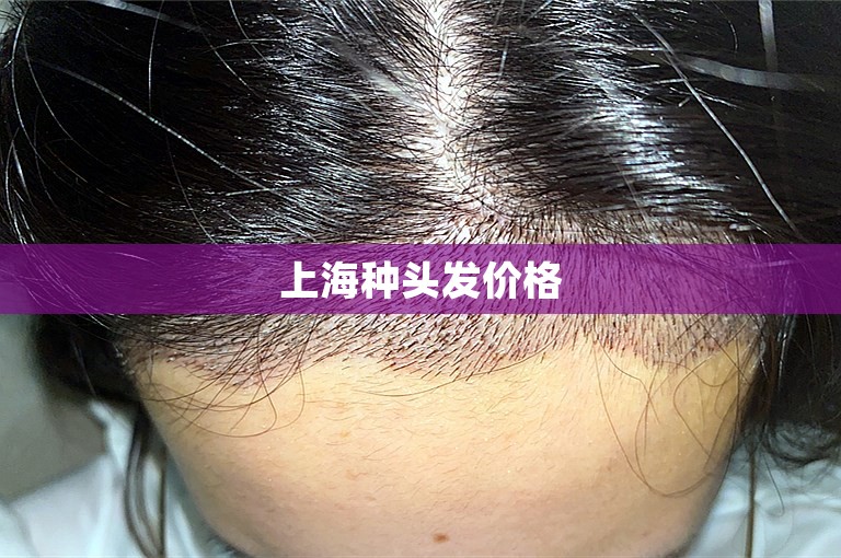 上海种头发价格