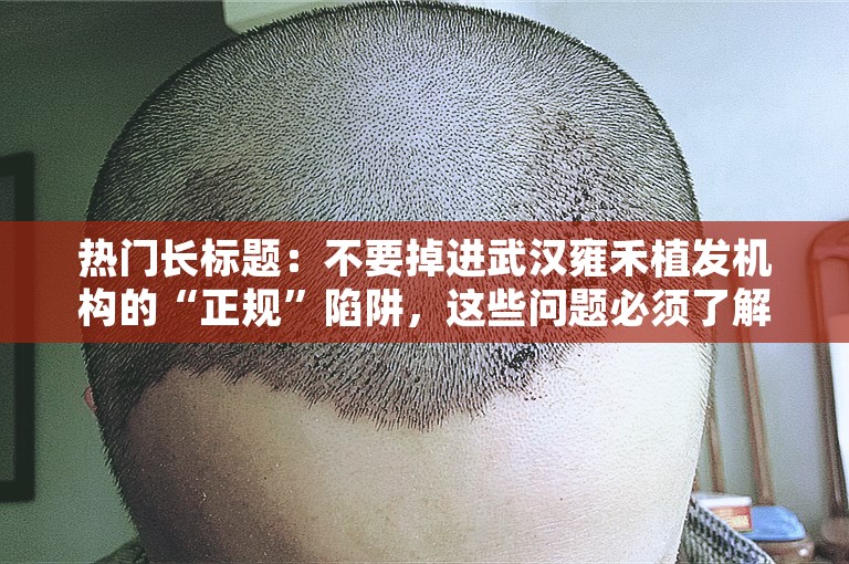热门长标题：不要掉进武汉雍禾植发机构的“正规”陷阱，这些问题必须了解！