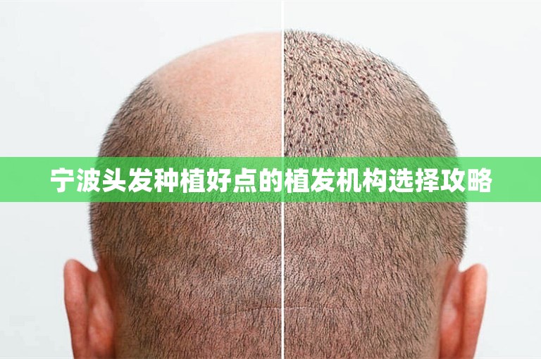 宁波头发种植好点的植发机构选择攻略
