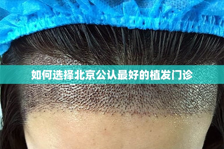 如何选择北京公认最好的植发门诊