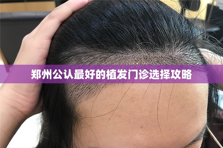 郑州公认最好的植发门诊选择攻略