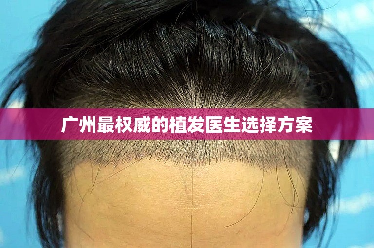 广州最权威的植发医生选择方案