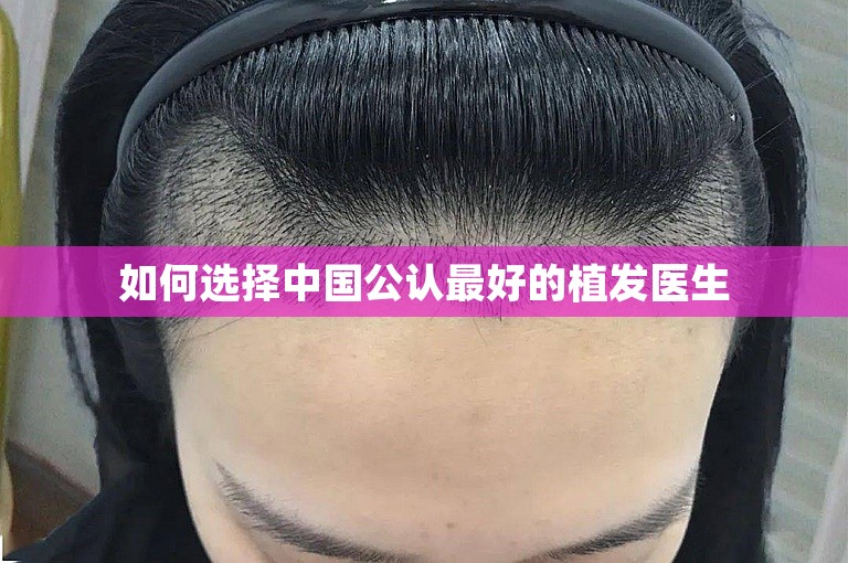 如何选择中国公认最好的植发医生