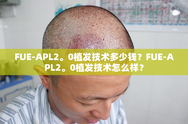FUE-APL2。0植发技术多少钱？FUE-APL2。0植发技术怎么样？
