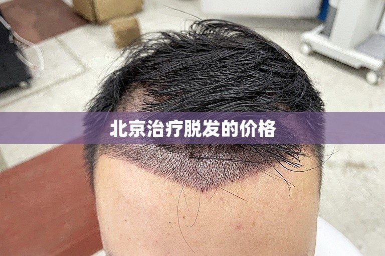 北京治疗脱发的价格