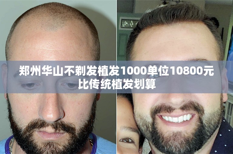 郑州华山不剃发植发1000单位10800元比传统植发划算