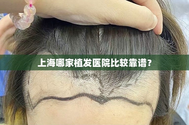 上海哪家植发医院比较靠谱？