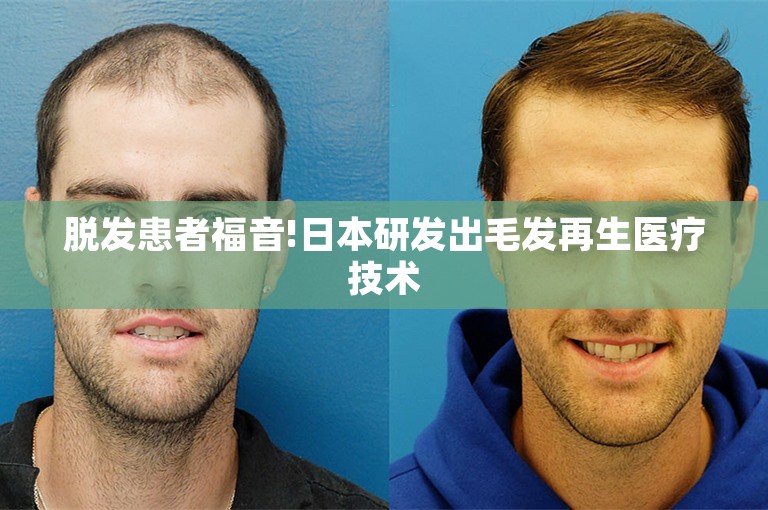脱发患者福音!日本研发出毛发再生医疗技术
