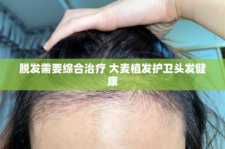脱发需要综合治疗 大麦植发护卫头发健康