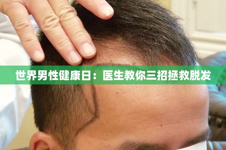 世界男性健康日：医生教你三招拯救脱发