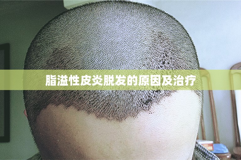 脂溢性皮炎脱发的原因及治疗
