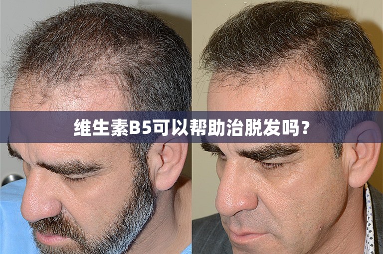 维生素B5可以帮助治脱发吗？