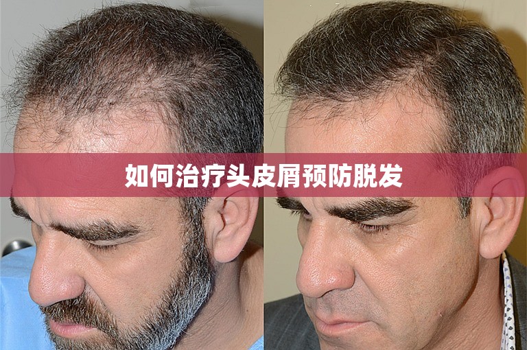 如何治疗头皮屑预防脱发