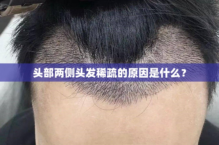 头部两侧头发稀疏的原因是什么? 头部两侧头发稀疏的原因是什么?