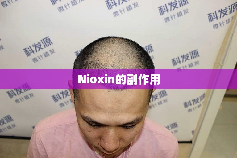Nioxin的副作用