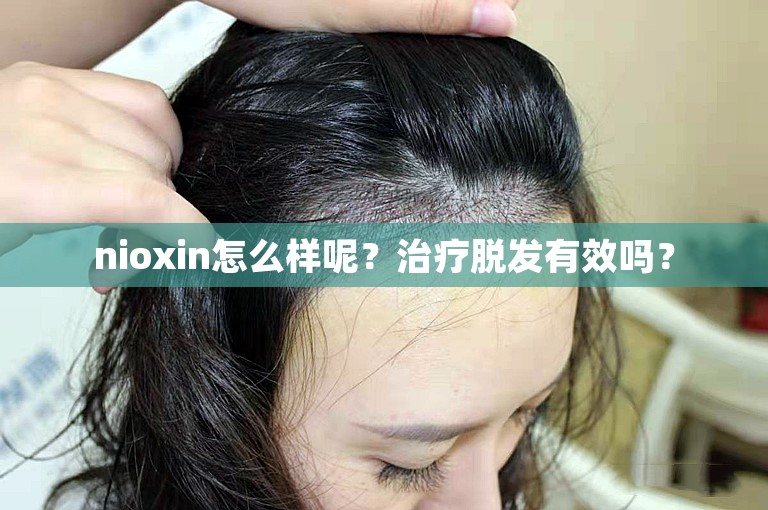 nioxin怎么样呢？治疗脱发有效吗？