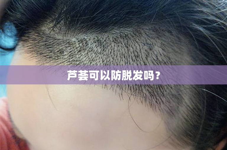芦荟可以防脱发吗？