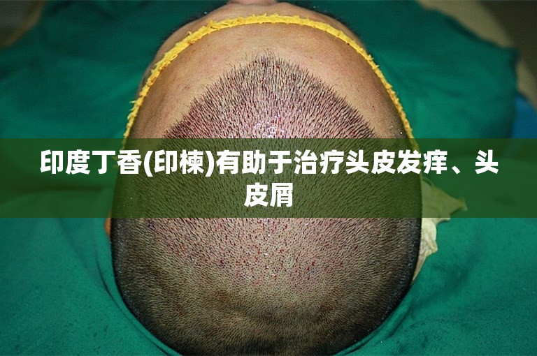 印度丁香(印楝)有助于治疗头皮发痒、头皮屑