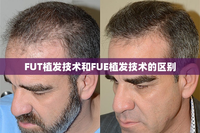 FUT植发技术和FUE植发技术的区别