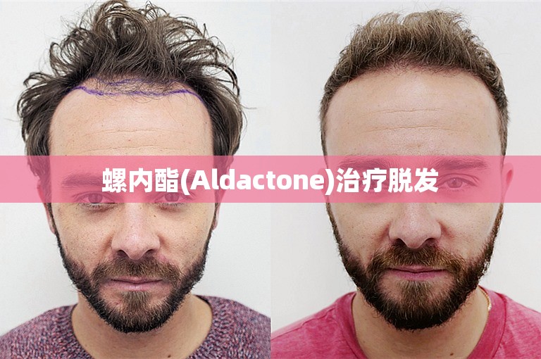 螺内酯(Aldactone)治疗脱发