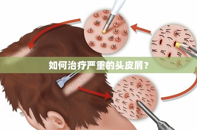 如何治疗严重的头皮屑？