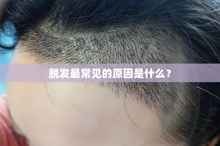 脱发最常见的原因是什么？