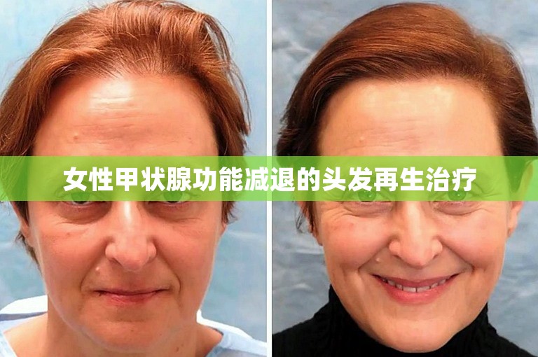 女性甲状腺功能减退的头发再生治疗