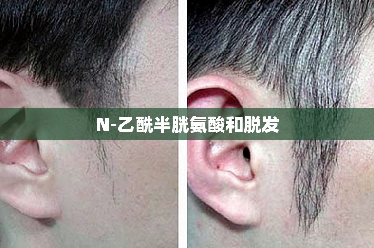 N-乙酰半胱氨酸和脱发