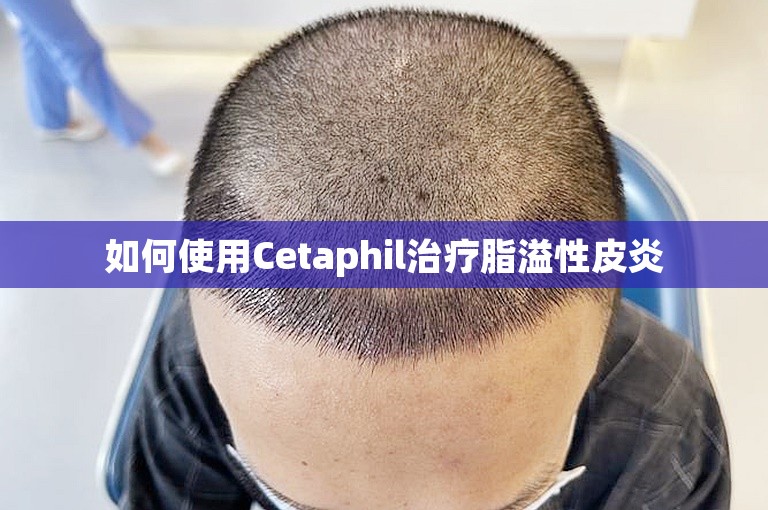 如何使用Cetaphil治疗脂溢性皮炎