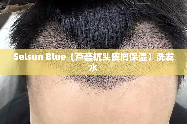 Selsun Blue（芦荟抗头皮屑保湿）洗发水