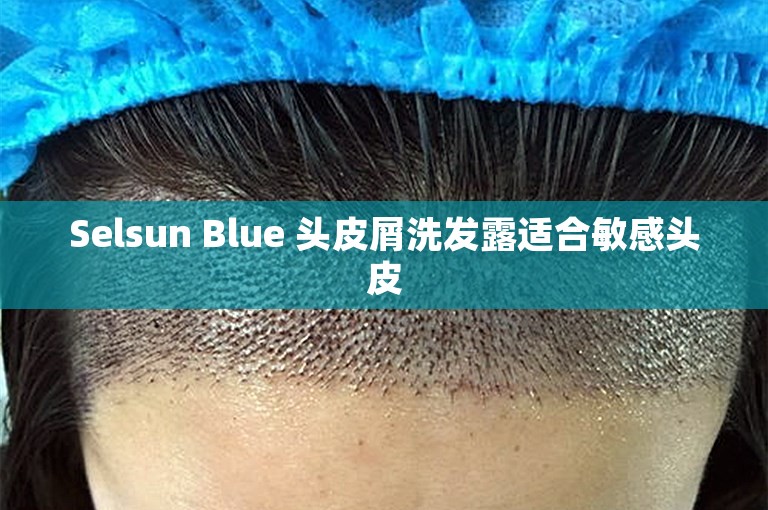Selsun Blue 头皮屑洗发露适合敏感头皮